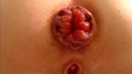 Huge Prolapse Stretched After Hard Anal Pumping - Pussy Pump, Squirt [HD/Mp4/1000 MB]